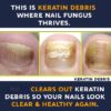 Nail Gel Restores Fungus Damaged Nails, a Clinically Proven Toenail Treatment, 90% of Nails Improve, Money-Back Guaranteed, 4 oz