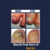 Nail Gel Restores Fungus Damaged Nails, a Clinically Proven Toenail Treatment, 90% of Nails Improve, Money-Back Guaranteed, 4 oz