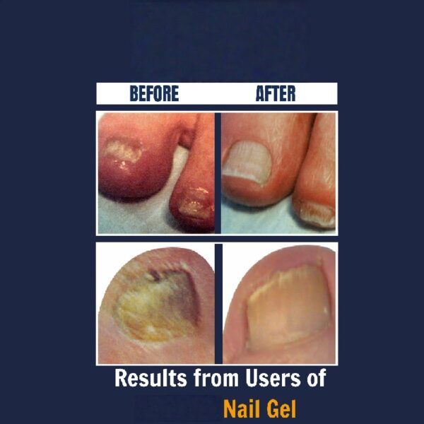 Nail Gel Restores Fungus Damaged Nails, a Clinically Proven Toenail Treatment, 90% of Nails Improve, Money-Back Guaranteed, 4 oz