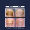Nail Gel Restores Fungus Damaged Nails, a Clinically Proven Toenail Treatment, 90% of Nails Improve, Money-Back Guaranteed, 4 oz