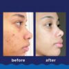 (3 pack) Foaming Acne Wash, 10% Benzoyl Peroxide, Maximum Strength - 5.5 oz