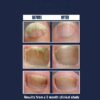 Nail Gel Restores Fungus Damaged Nails, a Clinically Proven Toenail Treatment, 90% of Nails Improve, Money-Back Guaranteed, 4 oz