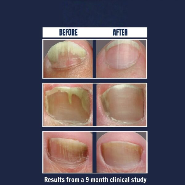 Nail Gel Restores Fungus Damaged Nails, a Clinically Proven Toenail Treatment, 90% of Nails Improve, Money-Back Guaranteed, 4 oz