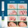Nail Repair Pen – 25% Undecylenic Acid Toenail Fungus Treatment Extra Strength, Advanced Treatment for Damaged Nails, Nail Softener, Ingrown Toenail Support Foot Care Formula 4PCS