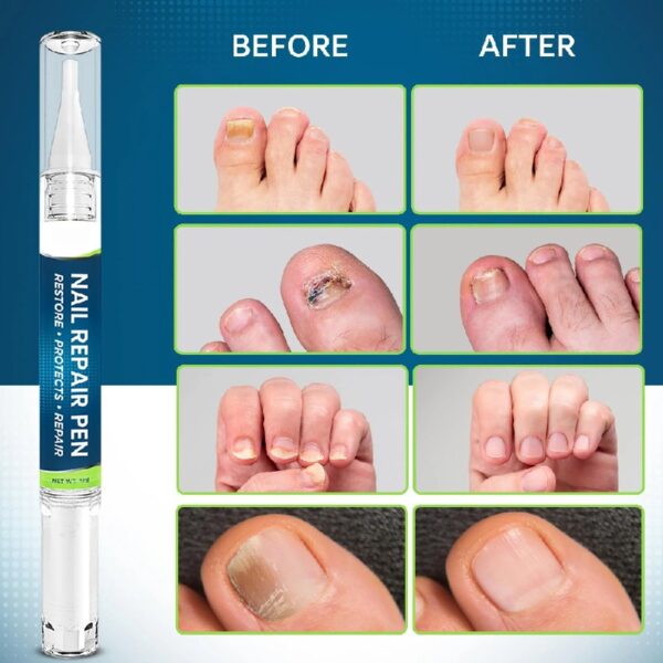 Nail Repair Pen – 25% Undecylenic Acid Toenail Fungus Treatment Extra Strength, Advanced Treatment for Damaged Nails, Nail Softener, Ingrown Toenail Support Foot Care Formula 4PCS
